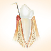 Zahnfleischentzündung (Gingivitis)